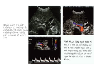 Động mạch thận (P)	
khảo sát từ hướng cắt
chếch (bệnh nhân nằm
chếch phải – sau)	lấy
gan làm cửa sổ xuyên
âm
 