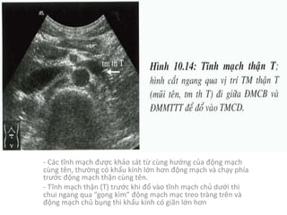 - Các tĩnh mạch được khảo sát từ cùng hướng của động mạch
cùng tên,	thường có khẩu kính lớn hơn động mạch và chạy phía
trước động mạch thận cùng tên.
- Tĩnh mạch thận (T)	trước khi đổ vào tĩnh mạch chủ dưới thì
chui ngang qua	“gọng kìm”	động mạch mạc treo tràng trên và
động mạch chủ bụng thì khẩu kính có giãn lớn hơn
 