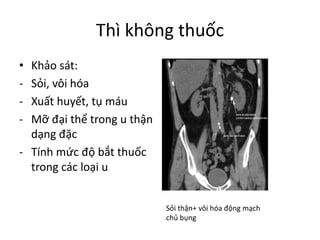 Thì không thuốc
• Khảo sát:
- Sỏi,	vôi hóa
- Xuất huyết,	tụ máu
- Mỡ đại thể trong u	thận
dạng đặc
- Tính mức độ bắt thuốc
trong các loại u
Sỏi thận+	vôi hóa động mạch
chủ bụng
 