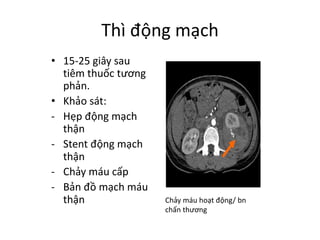 Thì động mạch
• 15-25	giây sau
tiêm thuốc tương
phản.
• Khảo sát:
- Hẹp động mạch
thận
- Stent	động mạch
thận
- Chảy máu cấp
- Bản đồ mạch máu
thận Chảy máu hoạt động/	bn
chấn thương
 