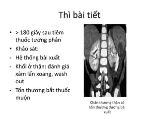 Thì bài tiết
• >	180	giây sau tiêm
thuốc tương phản
• Khảo sát:
- Hệ thống bài xuất
- Khối ở	thận:	đánh giá
xâm lấn xoang,	wash	
out
- Tổn thương bắt thuốc
muộn
Chấn thương thận có
tổn thương đường bài
xuất
 