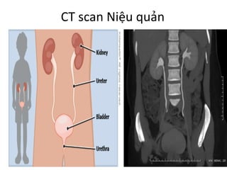 CT	scan	Niệu quản
 