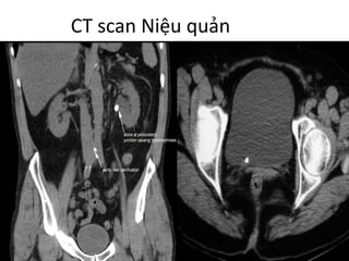 CT	scan	Niệu quản
 