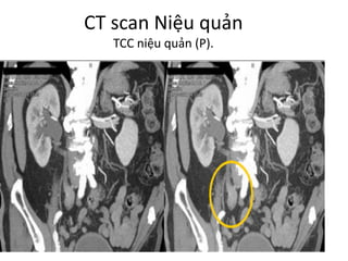 CT	scan	Niệu quản
TCC	niệu quản (P).
 