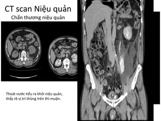 CT	scan	Niệu quản
Chấn thương niệu quản
Thoát nước tiểu ra khỏi niệu quản,	
thấy rõ vị trí thủng trên thì muộn.
 