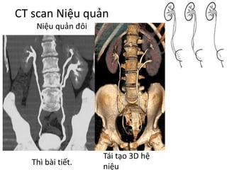 CT	scan	Niệu quản
Niệu quản đôi
Thì bài tiết.
Tái tạo 3D	hệ
niệu
 