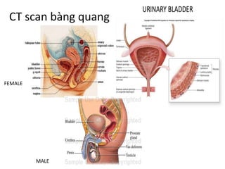 CT	scan	bàng quang
FEMALE
MALE
 