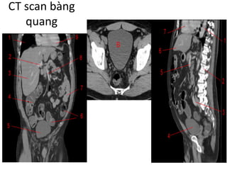 CT	scan	bàng
quang
 