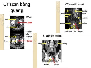 CT	scan	bàng
quang
 