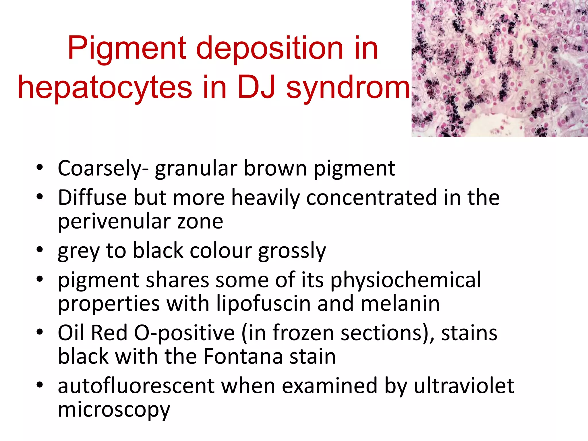 Pigment deposition in
hepatocytes in DJ syndrome
• Coarsely- granular brown pigment
• Diffuse but more heavily concentrated in the
perivenular zone
• grey to black colour grossly
• pigment shares some of its physiochemical
properties with lipofuscin and melanin
• Oil Red O-positive (in frozen sections), stains
black with the Fontana stain
• autofluorescent when examined by ultraviolet
microscopy
 