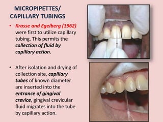 MICROPIPETTES/
CAPILLARY TUBINGS
• Krasse and Egelberg (1962)
were first to utilize capillary
tubing. This permits the
collection of fluid by
capillary action.
• After isolation and drying of
collection site, capillary
tubes of known diameter
are inserted into the
entrance of gingival
crevice, gingival crevicular
fluid migrates into the tube
by capillary action.
 