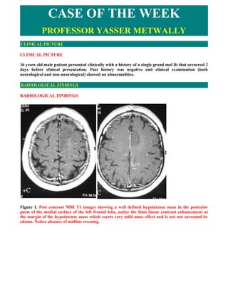 CASE OF THE WEEK
           PROFESSOR YASSER METWALLY
CLINICAL PICTURE

CLINICAL PICTURE

36 years old male patient presented clinically with a history of a single grand mal fit that occurred 2
days before clinical presentation. Past history was negative and clinical examination (both
neurological and non-neurological) showed no abnormalities.

RADIOLOGICAL FINDINGS

RADIOLOGICAL FINDINGS  




Figure 1. Post contrast MRI T1 images showing a well defined hypointense mass in the posterior
parts of the medial surface of the left frontal lobe, notice the faint linear contrast enhancement at
the margin of the hypointense mass which exerts very mild mass effect and is not not surround be
edema. Notice absence of midline crossing.
 