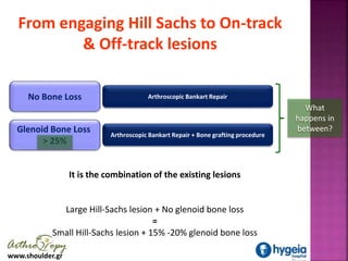 www.shoulder.gr
From engaging Hill Sachs to On-track
& Off-track lesions
No Bone Loss Arthroscopic Bankart Repair
Glenoid ...