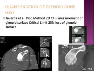 www.shoulder.gr
 Taverna et al. Pico Method 2D CT – measurement of
glenoid surface Critical Limit 25% loss of glenoid
sur...