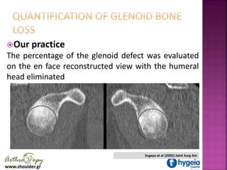 www.shoulder.gr
Our practice
The percentage of the glenoid defect was evaluated
on the en face reconstructed view with th...
