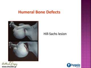 www.shoulder.gr
Humeral Bone Defects
Hill-Sachs lesion
 