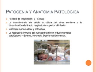 PATOGENIA Y ANATOMÍA PATOLÓGICA
 Periodo de Incubación: 3 - 5 días
 La transferencia de célula a célula del virus conlleva a la
diseminación del tracto respiratorio superior al inferior.
 Infiltrado mononuclear y linfocitico.
 La respuesta inmune del huésped también induce cambios
patológicos.= Edema, Necrosis, Descamación celular.
 