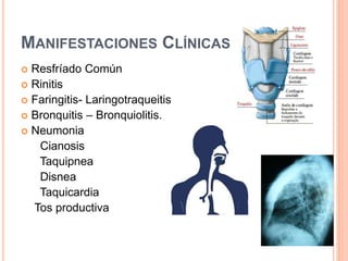 MANIFESTACIONES CLÍNICAS
 Resfríado Común
 Rinitis
 Faringitis- Laringotraqueitis
 Bronquitis – Bronquiolitis.
 Neumonia
Cianosis
Taquipnea
Disnea
Taquicardia
Tos productiva
 