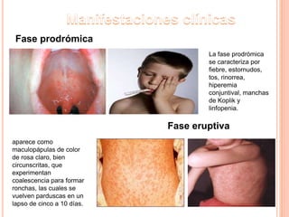 Fase prodrómica
La fase prodrómica
se caracteriza por
fiebre, estornudos,
tos, rinorrea,
hiperemia
conjuntival, manchas
de Koplik y
linfopenia.
Fase eruptiva
aparece como
maculopápulas de color
de rosa claro, bien
circunscritas, que
experimentan
coalescencia para formar
ronchas, las cuales se
vuelven parduscas en un
lapso de cinco a 10 días.
 