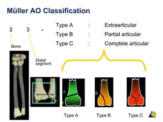 Müller AO Classification
Type A : Extraarticular
Type B : Partial articular
Type C : Complete articular
Distal
segment
Bone
-2 3
Type BType A Type C
 