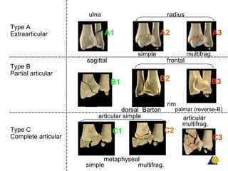 Type A
Extraarticular
Type B
Partial articular
A1 A2 A3
B1 B3B2
sagittal frontal
multifrag.simple
rim
palmar (reverse-B))dorsal (Barton)
C1 C2
ulna radius
metaphyseal
simple multifrag.
articular simple articular
multifrag.
C3
Type C
Complete articular
 