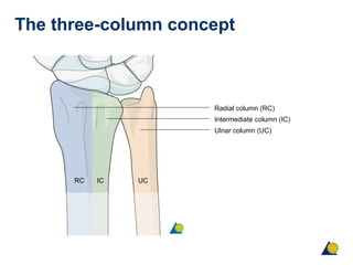 The three-column concept
Radial column (RC)
Intermediate column (IC)
Ulnar column (UC)
RC IC UC
 