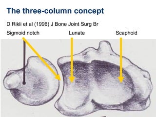 The three-column concept
D Rikli et al (1996) J Bone Joint Surg Br
Sigmoid notch Lunate Scaphoid
 