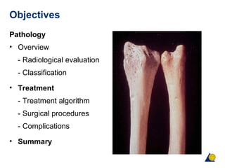 Objectives
Pathology
• Overview
- Radiological evaluation
- Classification
• Treatment
- Treatment algorithm
- Surgical procedures
- Complications
• Summary
 