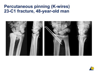 Percutaneous pinning (K-wires)
23-C1 fracture, 48-year-old man
 