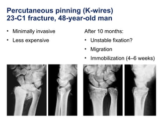 Percutaneous pinning (K-wires)
23-C1 fracture, 48-year-old man
• Minimally invasive
• Less expensive
After 10 months:
• Unstable fixation?
• Migration
• Immobilization (4–6 weeks)
 