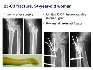23-C3 fracture, 54-year-old woman
1 month after surgery • Limited ORIF, hydroxyapatite
(Norian) graft,
• K-wires & external fixator
 