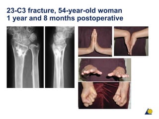 23-C3 fracture, 54-year-old woman
1 year and 8 months postoperative
 