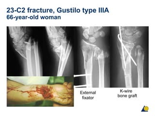 23-C2 fracture, Gustilo type IIIA
66-year-old woman
External
fixator
K-wire
bone graft
 