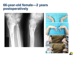 66-year-old female—2 years
postoperatively
 