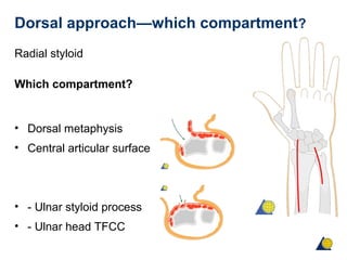 Dorsal approach—which compartment?
Radial styloid
Which compartment?
• Dorsal metaphysis
• Central articular surface
• - Ulnar styloid process
• - Ulnar head TFCC
 