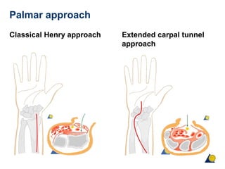 Palmar approach
Classical Henry approach Extended carpal tunnel
approach
 