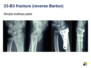 23-B3 fracture (reverse Barton)
Simple buttress plate
 
