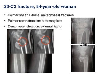 23-C3 fracture, 84-year-old woman
• Palmar shear + dorsal metaphyseal fractures
• Palmar reconstruction: buttress plate
• Dorsal reconstruction: external fixator
Cast
 