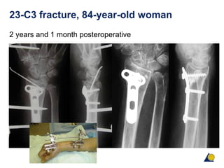 23-C3 fracture, 84-year-old woman
2 years and 1 month posteroperative
 