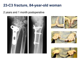 23-C3 fracture, 84-year-old woman
2 years and 1 month postoperative
 