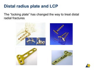 Distal radius plate and LCP
The “locking plate” has changed the way to treat distal
radial fractures
 