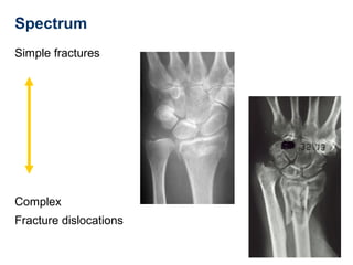 Spectrum
Simple fractures
Complex
Fracture dislocations
 