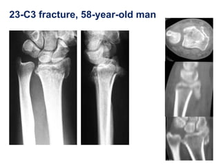 23-C3 fracture, 58-year-old man
 