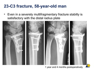 23-C3 fracture, 58-year-old man
• Even in a severely multifragmentary fracture stabilty is
satisfactory with the distal radius plate
1 year and 4 months postoperatively
 