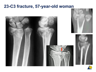 23-C3 fracture, 57-year-old woman
 