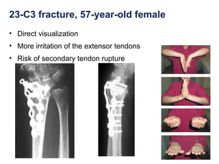 23-C3 fracture, 57-year-old female
• Direct visualization
• More irritation of the extensor tendons
• Risk of secondary tendon rupture
 