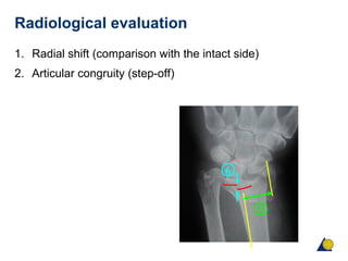 Radiological evaluation
1. Radial shift (comparison with the intact side)
2. Articular congruity (step-off)
5
6
 