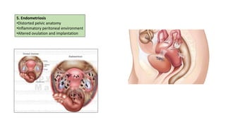 Infertility Overview Comprehensive Overview of Infertility: Causes, Diagnosis, and ...
