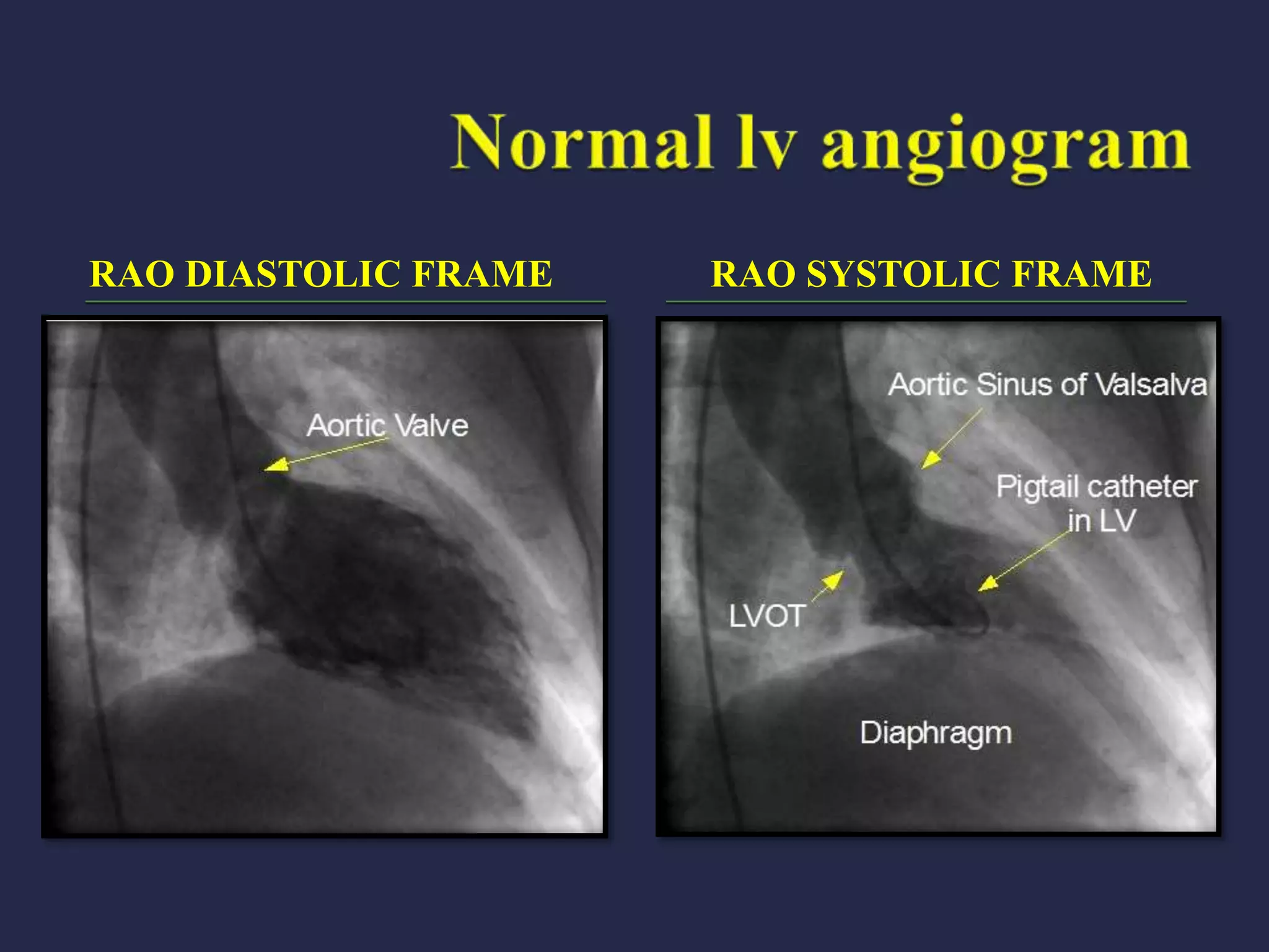RAO DIASTOLIC FRAME RAO SYSTOLIC FRAME
 