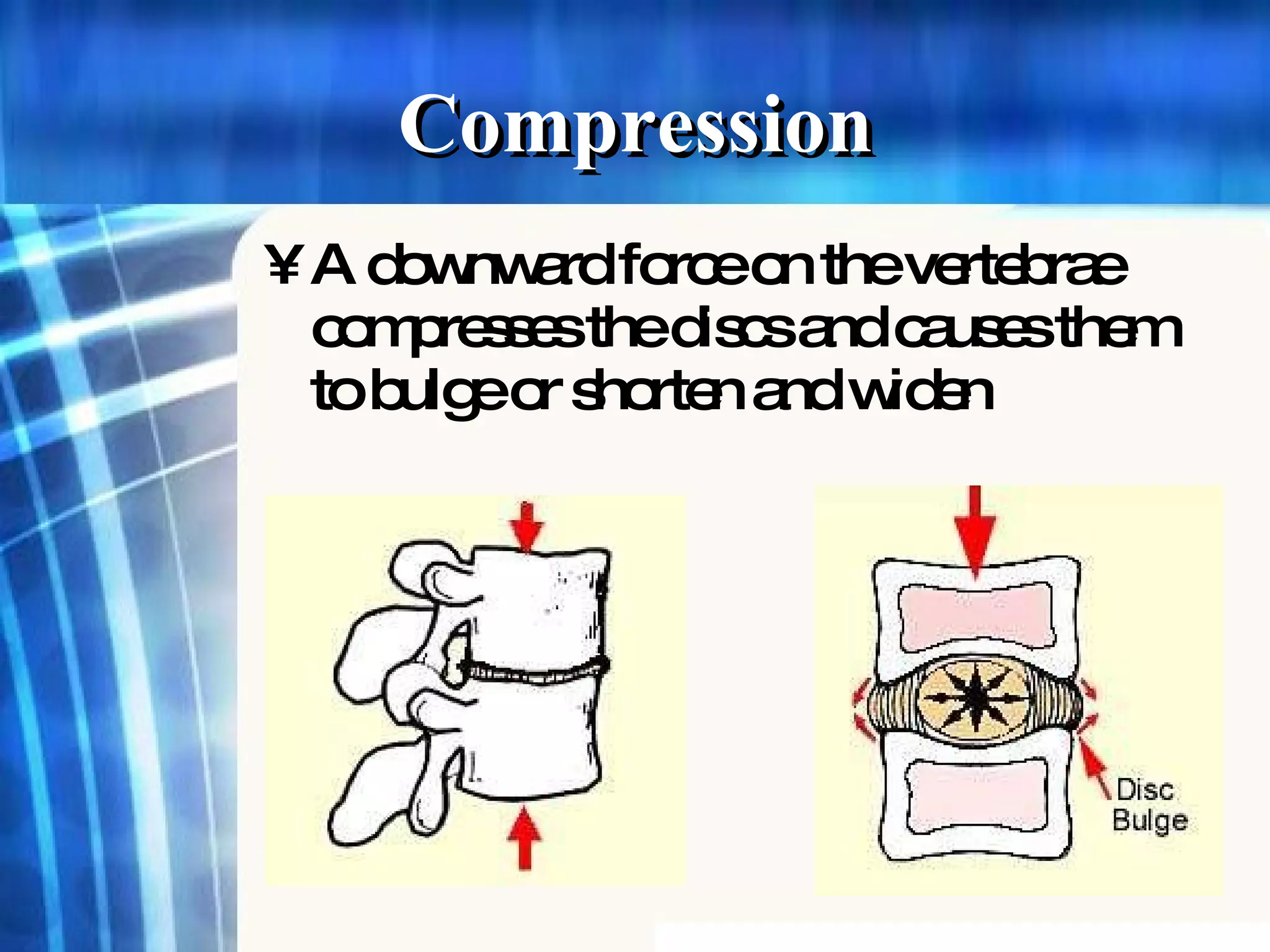 Compression   A downward force on the vertebrae compresses the discs and causes them to bulge or shorten and widen   